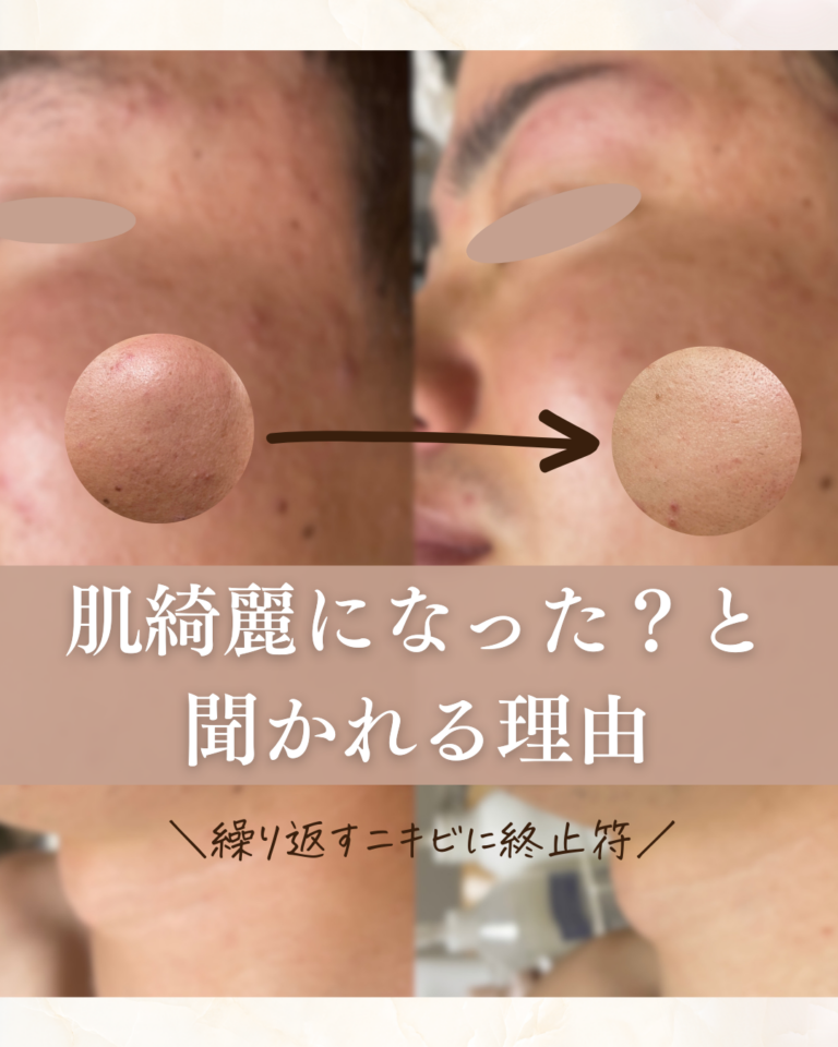 【症例写真あり】何をやってもダメだったニキビに終止符を。肌の凹凸・赤みをリセットする「マイクロラボ」の効果